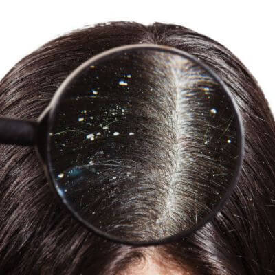 รังแค Dandruff เกิดจากเชื้อราบนหนังศรีษะ 3 รังแค 1